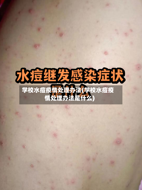 学校水痘疫情处理办法(学校水痘疫情处理办法是什么)